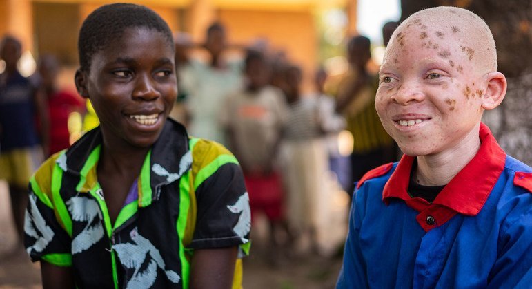 Inclusion is strength stresses UN marking Albinism Awareness Day